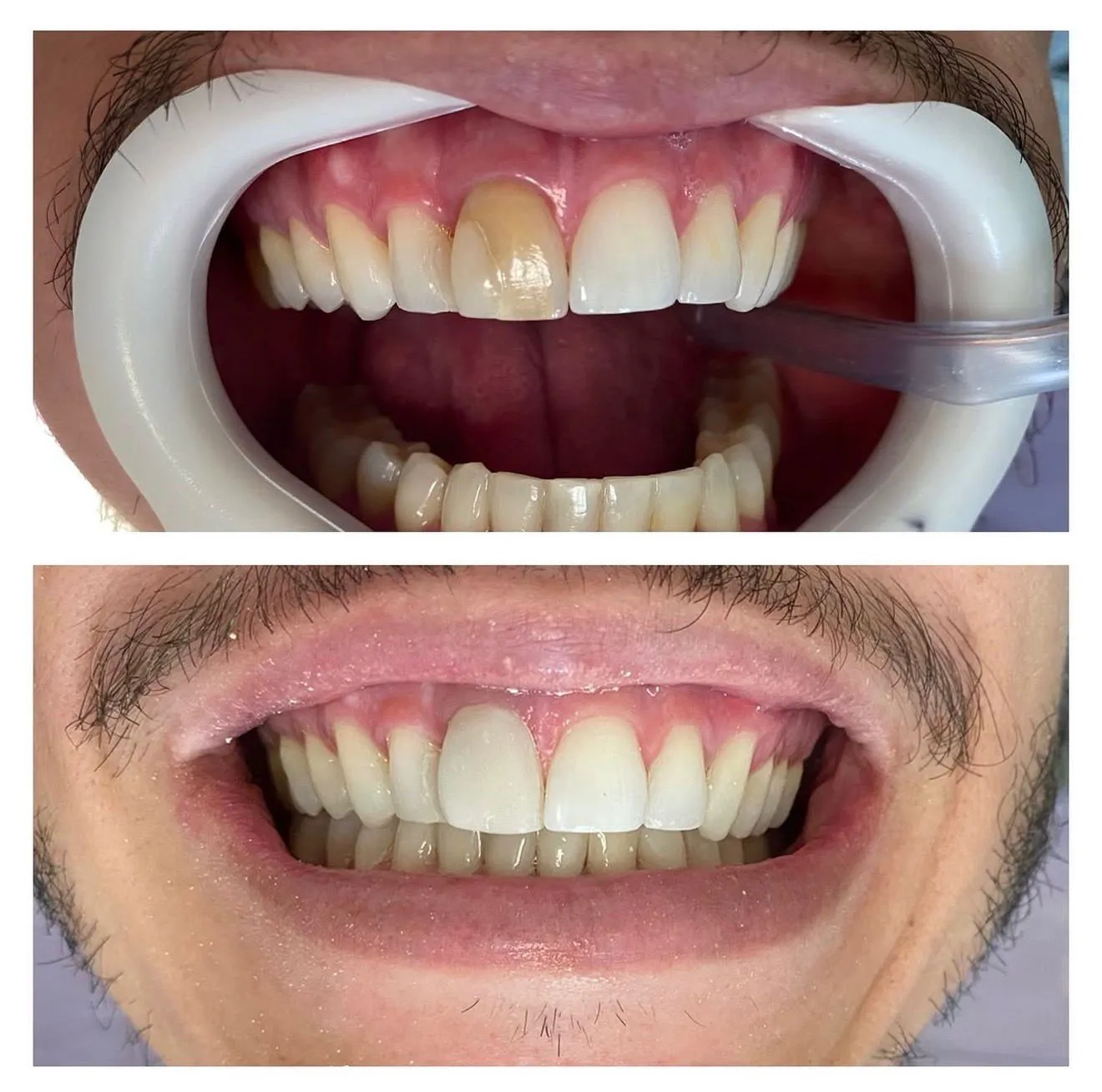 Antes e depois de clareamento dental: incisivo central escurecido devolvido à cor dos dentes vizinhos, sorriso uniforme, resultado da Dra. Mariana Nascimento