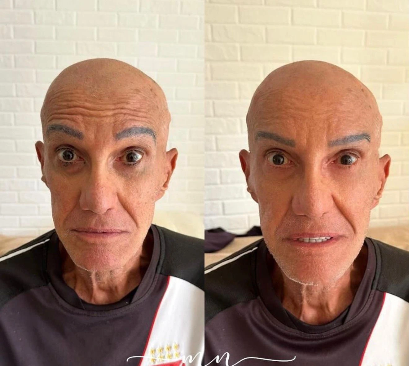 Antes e depois de harmonização facial: suavização das linhas de expressão do terço superior, resultado da Dra. Mariana Nascimento