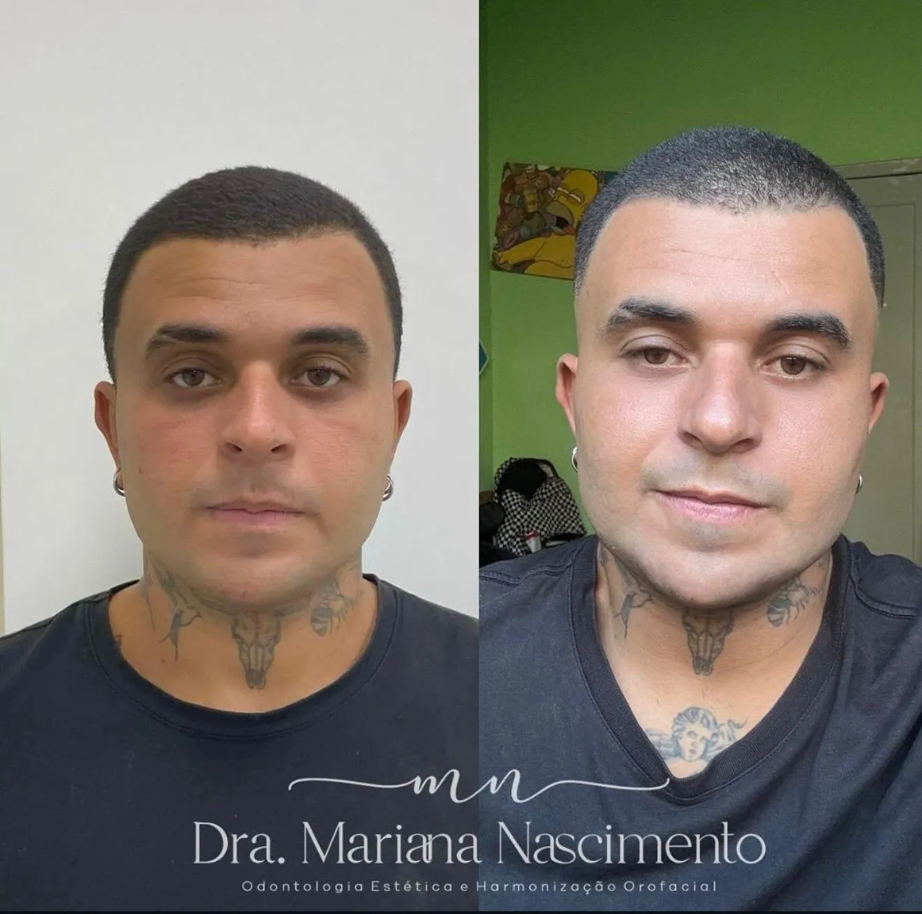 Antes e depois de harmonização orofacial: contorno facial mais definido e traços equilibrados, planejamento individualizado da Dra. Mariana Nascimento