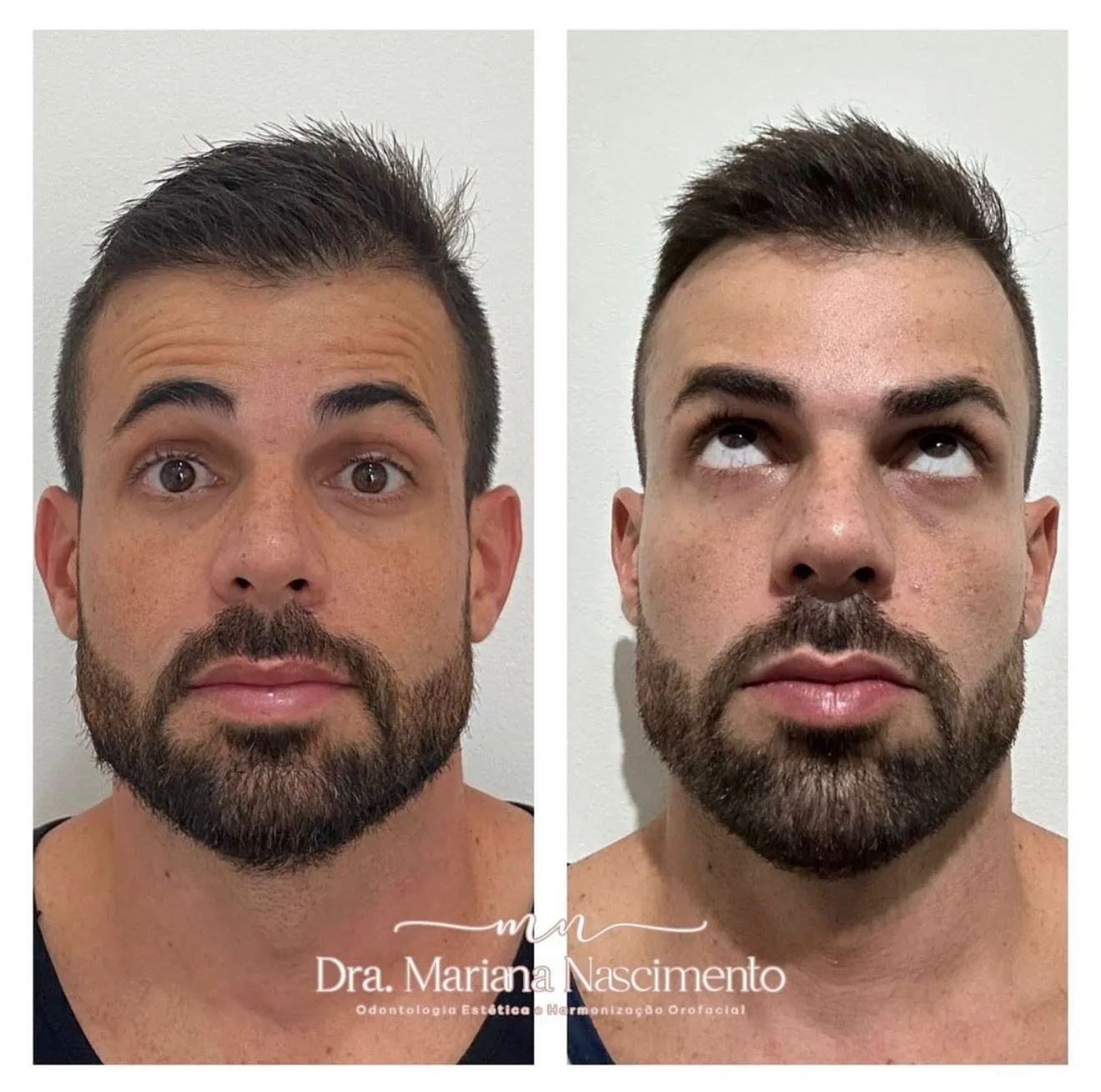 Antes e depois de suavização do terço superior: rugas da testa amenizadas sem perder o movimento natural da sobrancelha, resultado da Dra. Mariana Nascimento