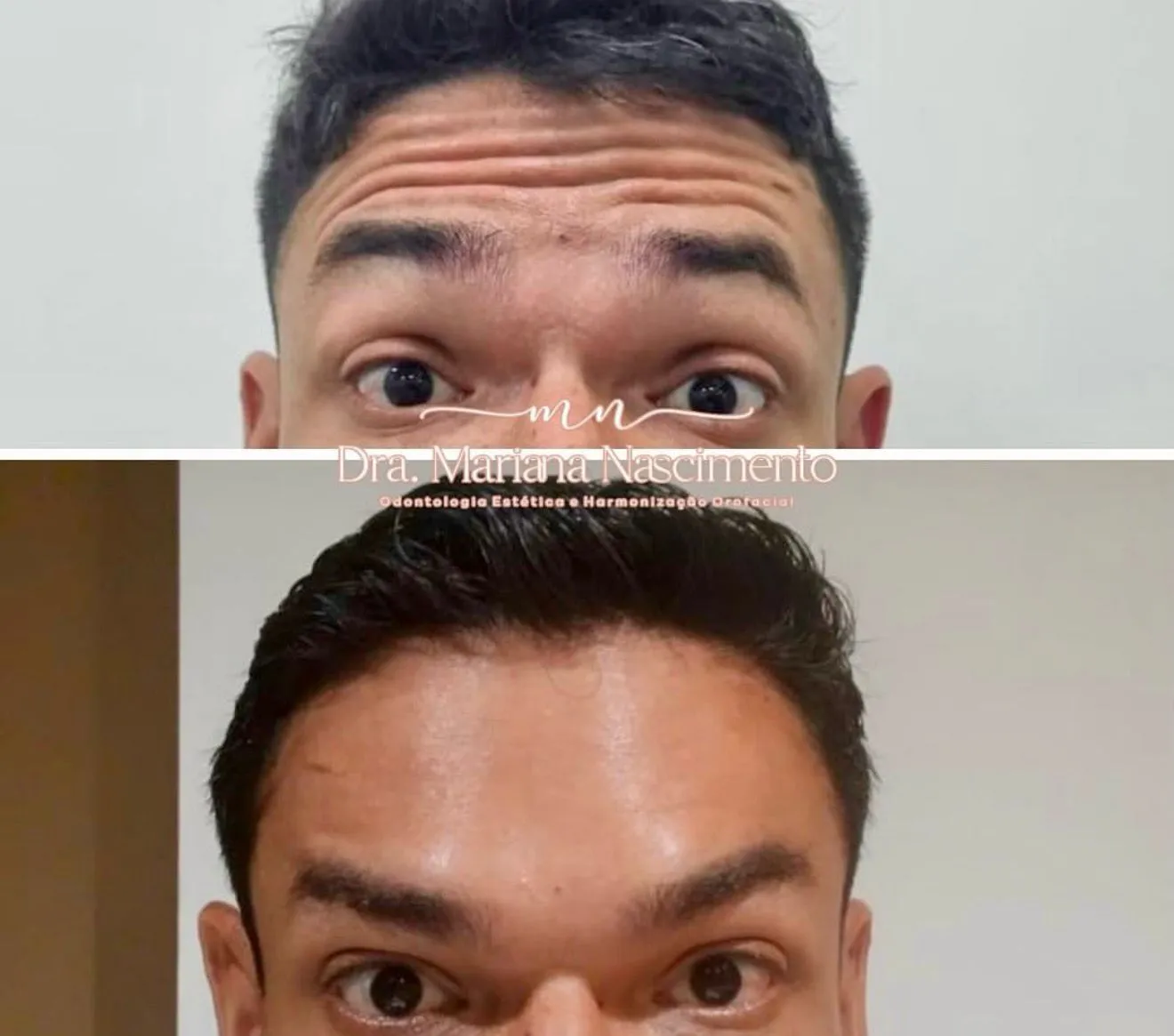 Antes e depois de tratamento estético para linhas de expressão: testa marcada por rugas horizontais e o resultado com a pele lisa, atendimento da Dra. Mariana Nascimento