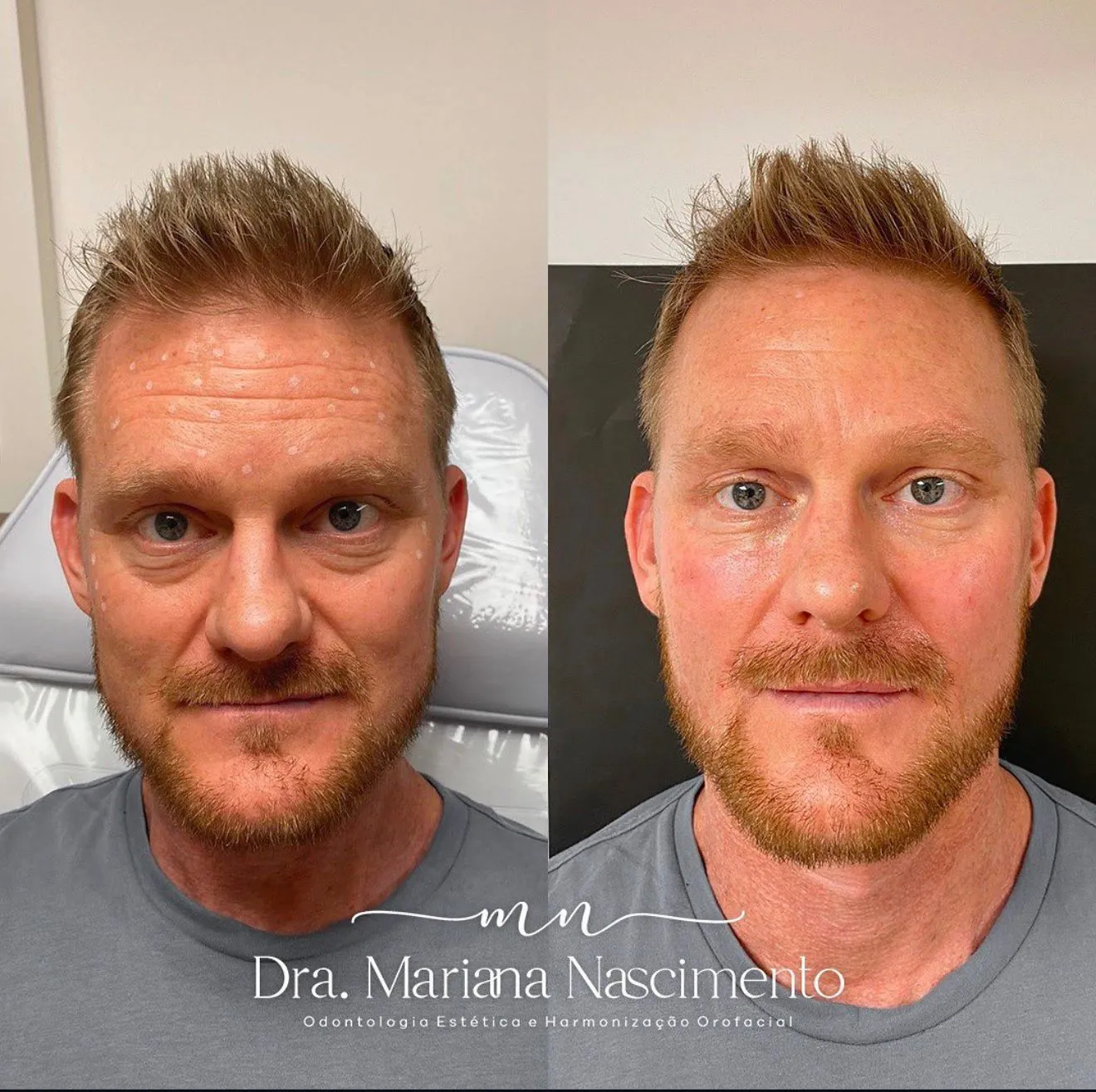 Antes e depois de procedimento injetável no terço superior: linhas horizontais da testa suavizadas com a expressão preservada, resultado da Dra. Mariana Nascimento